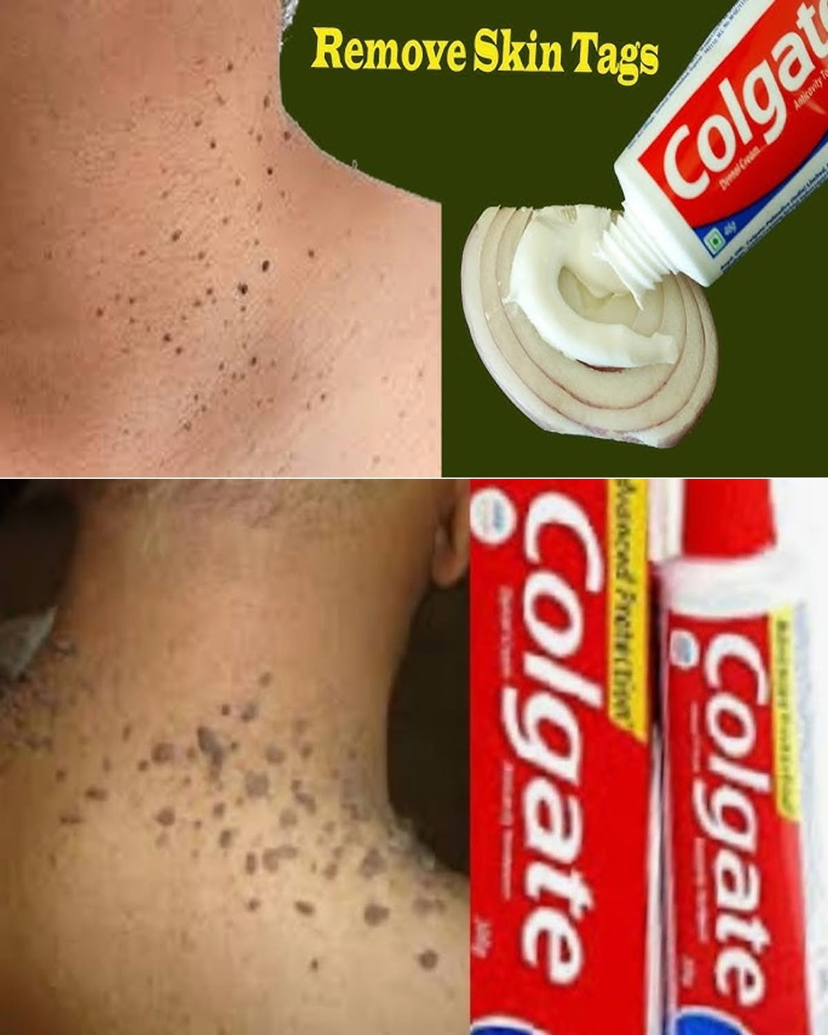 Remove Skin Tags Overnight with Vaseline