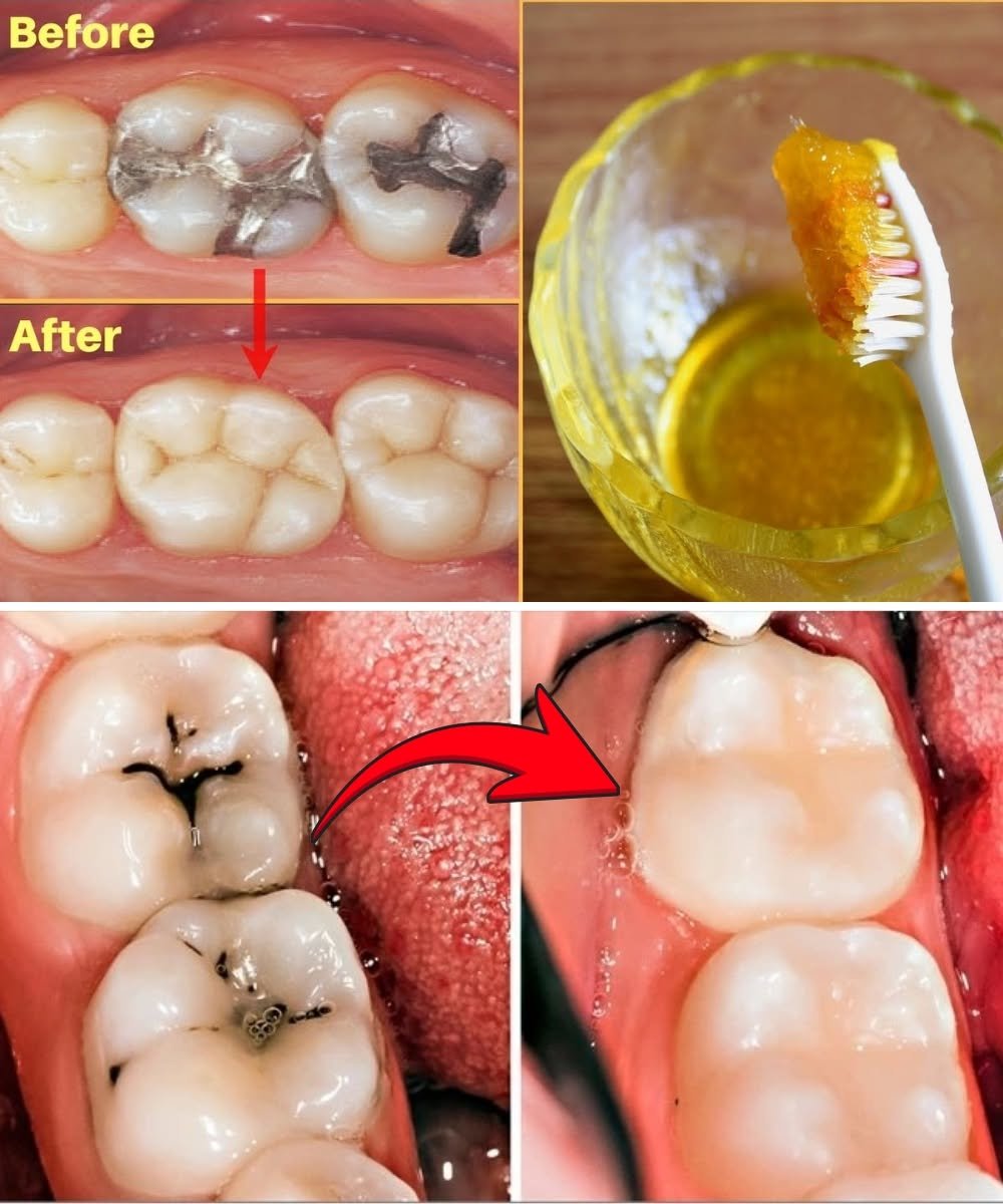 How to Get Rid of Tooth Cavity Naturally: Home Remedies to Help Reduce Tooth Pain