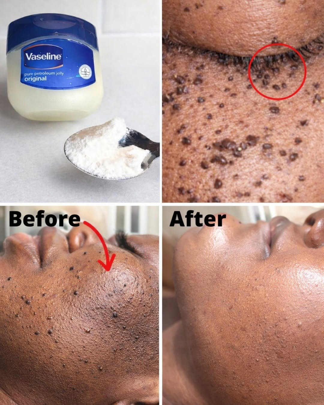 Those Stubborn Little White Bumps: Understanding Milia and Safe Ways to Improve Your Skin’s Appearance